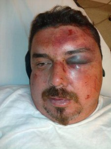 Chiclana says he sustained these injuries after an altercation with deputies in front of AV Hospital.